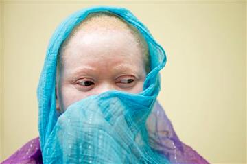 (AP Photo/Matt Rourke). Kabula Nkarango Masanja waits during a prosthetic limb fitting, Tuesday, Aug. 25, 2015, at Shriners Hospital for Children in Philadelphia. Kabula and four other children from Tanzania with the hereditary condition of albinism ar...