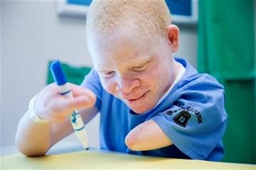 (AP Photo/Matt Rourke). Emmanuel Festo Rutema works with occupational therapist Alexis Jacobs Thursday, Aug. 27, 2015, at Shriners Hospital for Children in Philadelphia. Rutema and four other children from Tanzania with the hereditary condition of albi...